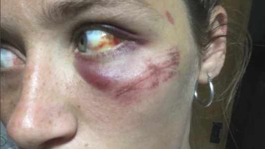 El calvario que vivió una joven que denunció a su ex novio: "Me convenció de que sus golpes tenían justificación"