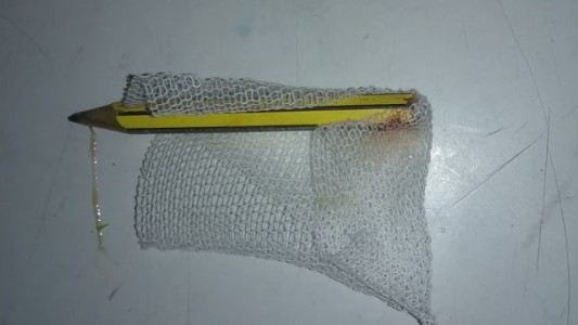 Una nena tuvo clavado un lápiz en el glúteo más de 3 meses