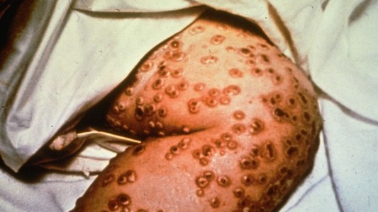 Primer virus erradicado: hace 40 años se declaraba el triunfo sobre la viruela