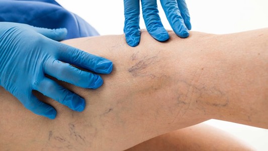 SALUD en 3 Minutos: Flebología y Sedentarismo