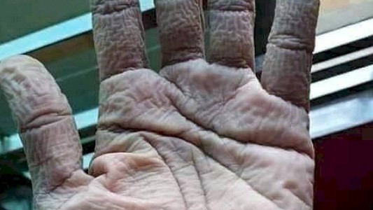 FOTO: así le quedó la mano a un medico tras usar los guantes protectores contra el coronavirus