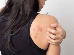 Un estudio afirma que las erupciones en la piel debe ser considerado como un síntoma de coronavirus