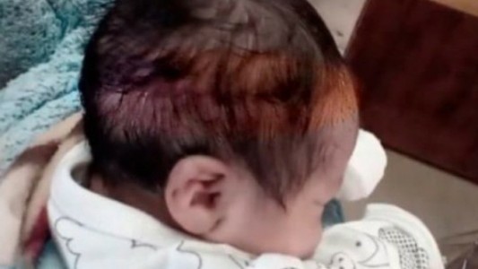 Un bebé recién nacido sufrió un corte de 15 centímetros en la cabeza durante la cesárea