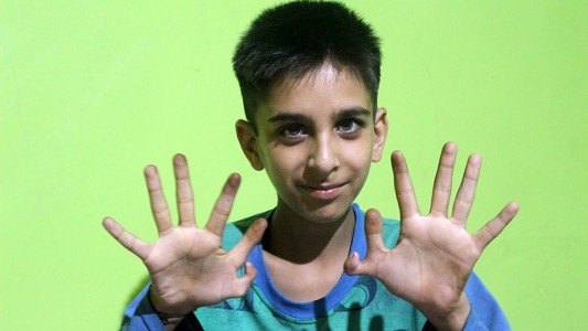 La historia del nene que nació con 4 dedos pulgares y sueña con ser médico para ayudar a otros chicos