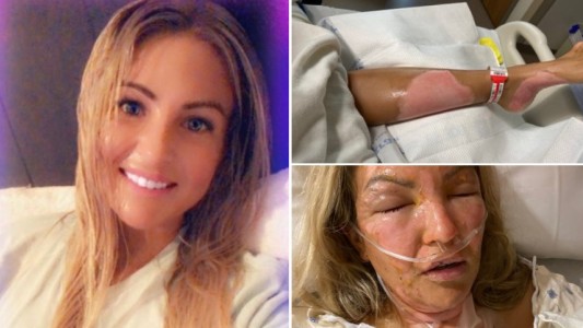 Encendió una vela tras usar desinfectante de manos y sufrió graves quemaduras