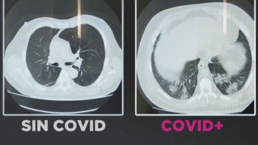 Así se ven los pulmones con y sin Coronavirus