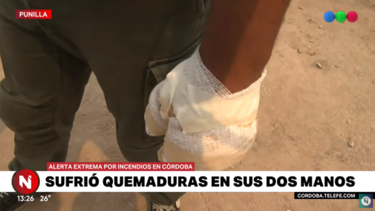 Se quemó las dos manos combatiendo los incendios