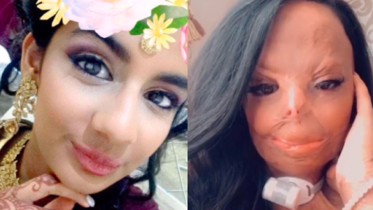 Se quemó al usar un champú contra los piojos y ahora es ejemplo de lucha: "Soy más fuerte que antes"