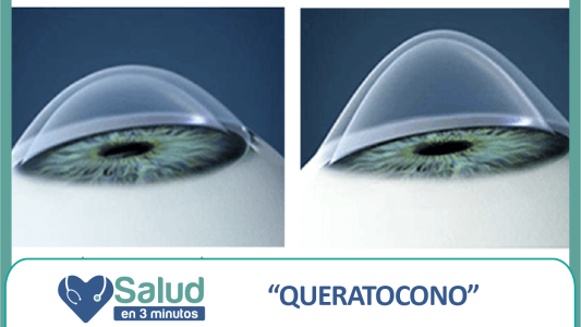 Queratocono: ¿Qué es y cómo puede tratarse?