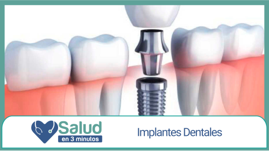 Implantes dentales: estabilidad, funcionalidad y seguridad personal