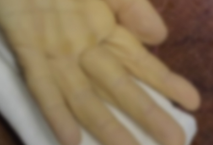 Exitoso trasplante de mano en el Hospital de Urgencias