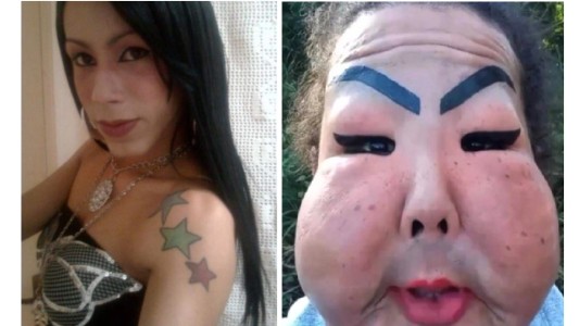 "Lamento habérmelo puesto": mujer trans se inyectó silicona industrial en la cara