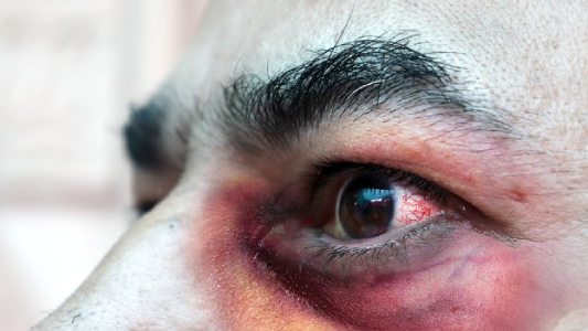 México registró su primer caso de Hongo Negro