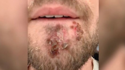 Usó la afeitadora de un amigo y se contagió de una bacteria carnívora