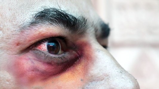 ¿Qué es el "hongo negro"?: por qué ya produjo la primera muerte en Argentina