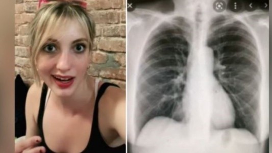 Fue al médico por una tos molesta y descubrieron que tenía el corazón del otro lado