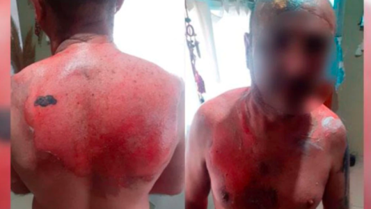 Anisacate: un hombre fue atacado por su expareja con agua hirviendo