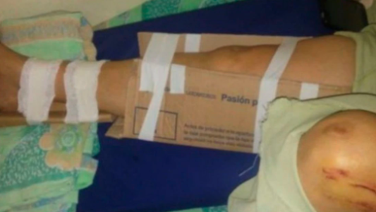 Llegó a un hospital de Chaco con una fractura expuesta y lo enyesaron con cartones