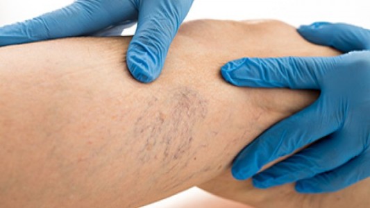 Salud en 3 Minutos: Varices, causas y posibles tratamientos