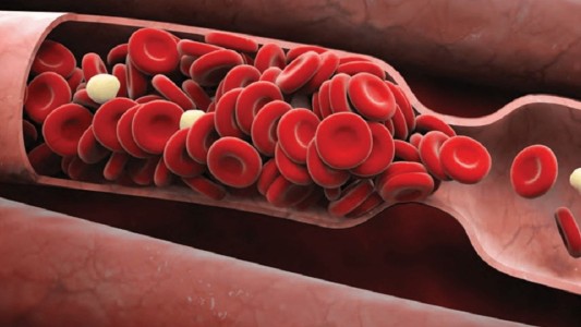 Día mundial de la Trombosis: La importancia vital de acceder a diagnósticos tempranos