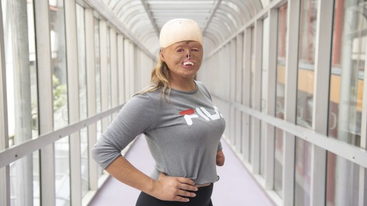 Brisa: a los 7 meses se quemó el 90% de su cuerpo y hoy es deportista y modelo