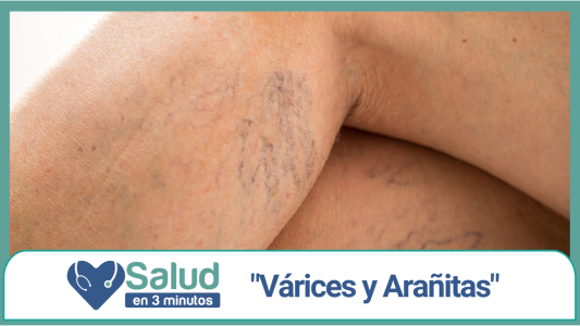 VÁRICES Y ARAÑITAS: una enfermedad crónica y evolutiva