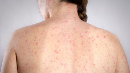 Alerta epidemiológico: El Ministerio de Salud informó un "posible caso" de sarampión en CABA