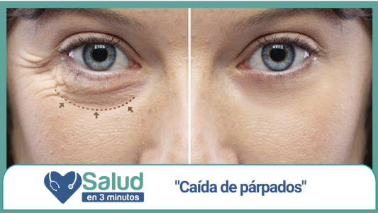 Salud en 3 Minutos: Caída de Párpados
