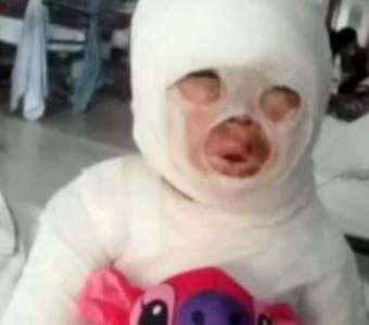 Una empleada de un restaurante se tropezó y le volcó aceite hirviendo a una nena de 3 años