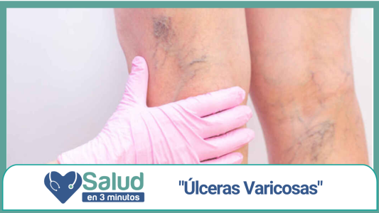 ¿Cuál es la causa de las úlceras varicosas?