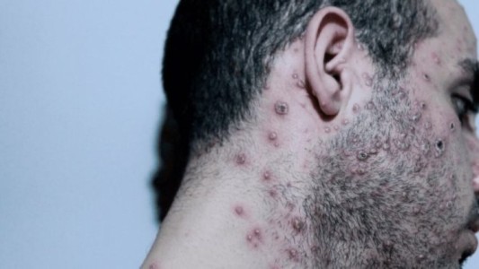Investigan el primer caso sospechoso de la viruela del mono en el país: cómo se propaga