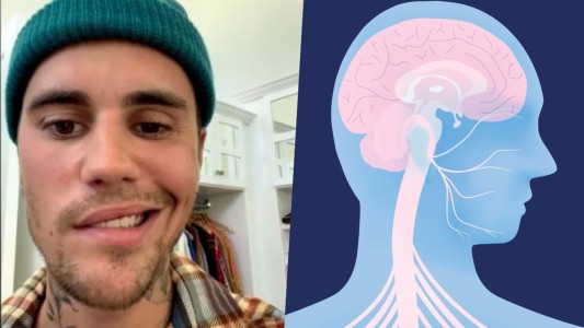 Qué es el Síndrome de Ramsay Hunt, la patología que le provocó parálisis facial a Justin Bieber