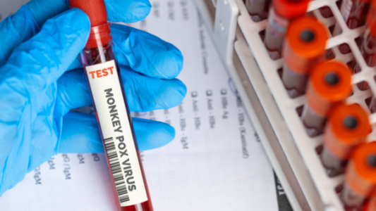 Dos nuevos casos de viruela del mono en Argentina