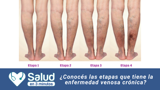 Hablamos de clasificación de várices