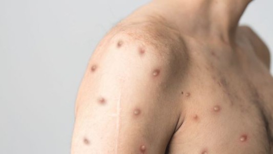 Viruela del mono: ya hay 24 casos confirmados en el país