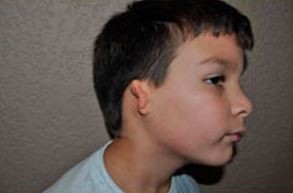 Investigan casos de microtia, una malformación congénita en la oreja que puede causar hipoacusia