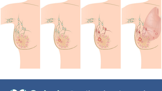 SALUD en 3 Minutos: Derribando mitos acerca del cáncer de mama