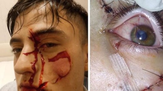 Vio a un amigo hablando con su ex novia y lo desfiguró: "¿Qué voy a hacer? Me cegué"