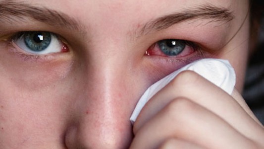 Misiones: Detectaron casos de conjuntivitis relacionados con enfermedades de trasmisión sexual