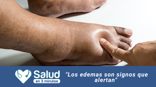 Edema: Un signo de una enfermedad de fondo