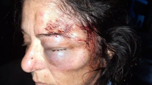 Desfiguraron a colectivera con brutal golpiza durante un robo