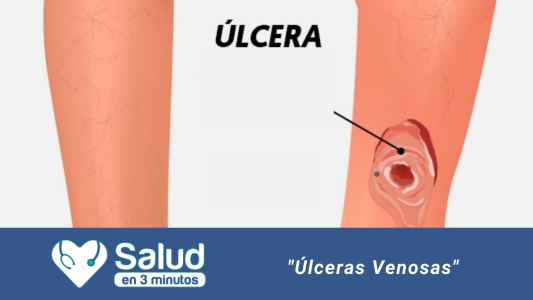 Úlceras varicosas: una complicación más grave de la insuficiencia venosa crónica
