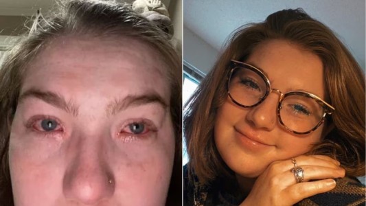 Insólito: una joven descubrió que es alérgica a su novio y explotaron las redes