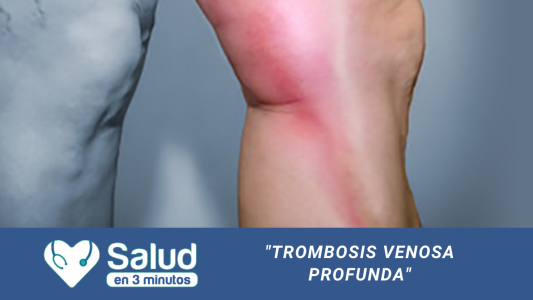 El reposo prolongado puede derivar en trombosis