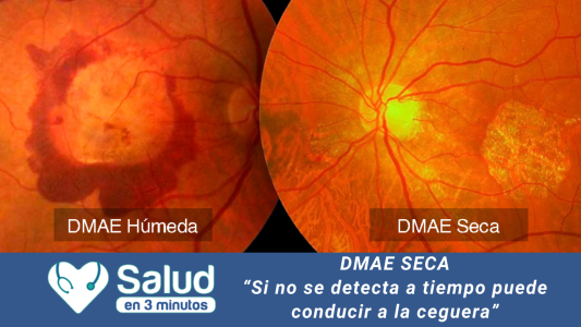 DEGENERACIÓN MACULAR SECA: “Detectarla a tiempo es la clave”