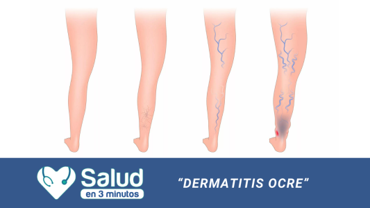 Dermatitis Ocre: una mancha marrón en la piel a la cual prestar atención si tenes varices