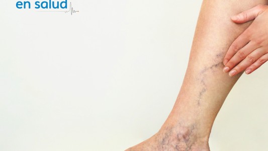 Várices en la tercera edad