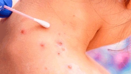 El Ministerio de Salud provincial presentó el protocolo de acción por la viruela del mono