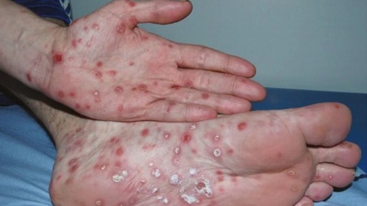 Preocupa un fuerte brote de sífilis en Argentina