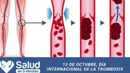 Alerta Trombosis: ¿Se puede prevenir?